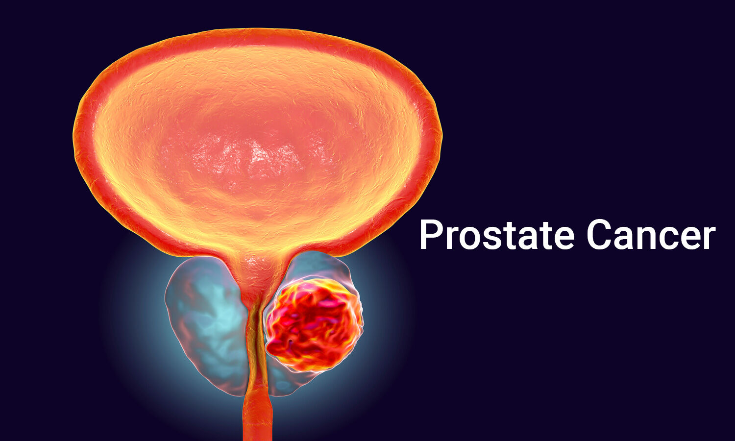 Prostate cancer diagnoses set to double by 2040 particularly in low income countries - Study 